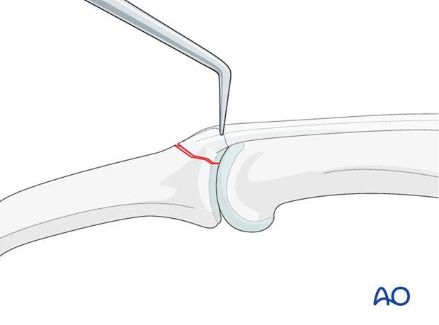 Put manual pressure on the palmar side of the middle phalanx. Complete the reduction with help of a dental pick.