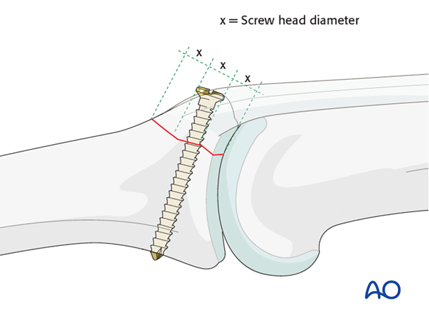 The maximal permitted diameter of the screw head is one third of the diameter of the avulsed fragment. 