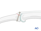 proximal dorsal avulsion fracture