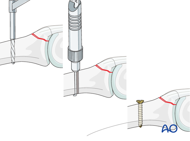 As the middle phalanx has a comparatively flat dorsal surface, it is sometimes difficult to drill a transverse hole. 