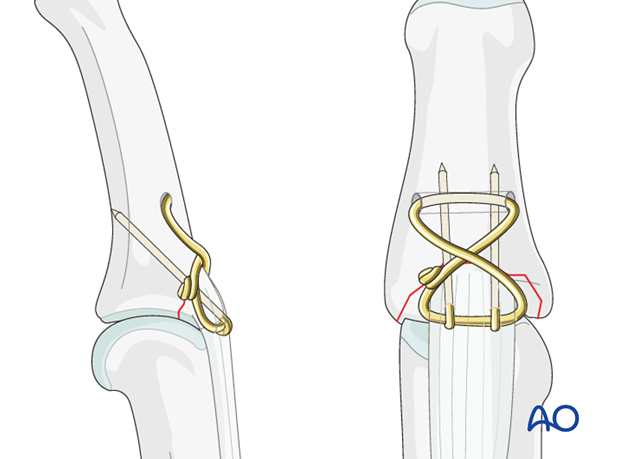 If the avulsed fragment is large enough, two 0.6 mm K-wires can be inserted to secure it to the main fragment of the middle ...