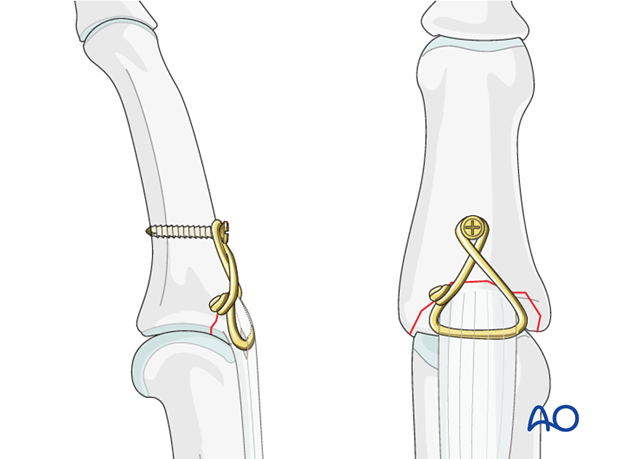 This drawing shows the alternative completed fixation with a screw anchor.