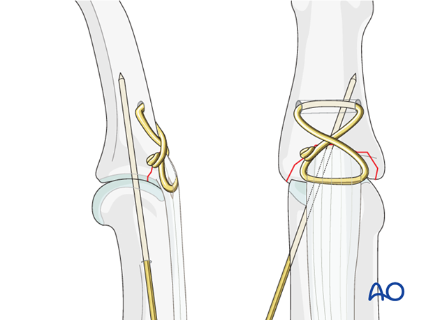 If there is any doubt about the stability of the fixation, insert a K-wire obliquely crossing the PIP joint. 