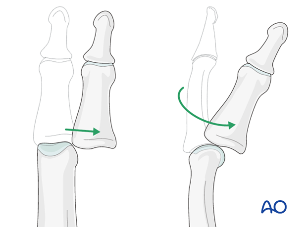 Dislocations of the PIP joint are classified according to the direction of displacement of the middle phalanx ...