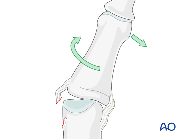 Typically, these injuries occur after lateral deviation and rotation, with the PIP joint in semi-flexion.