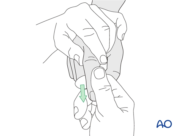 Apply traction to the finger, with the PIP joint in slight flexion, to relax the flexor tendons and the lateral band.