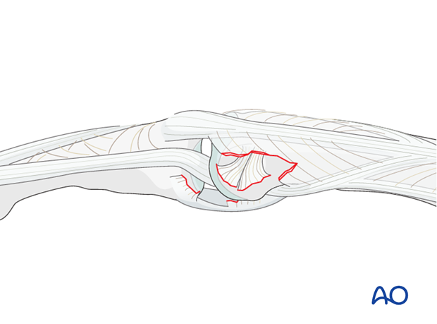 Check reduction with x-rays in two planes. The x-rays should show complete joint congruency. 