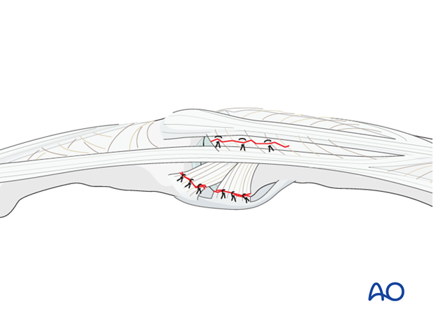 If the lateral band, or, more rarely, the central slip, or the collateral ligament, is trapped in the joint, use a dental ...