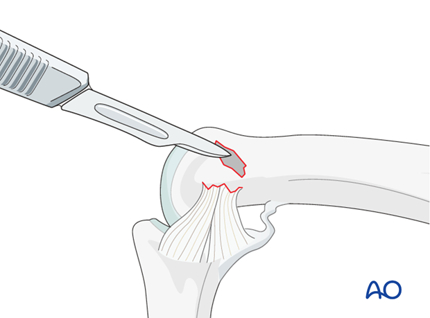 Using a scalpel, a tiny curette, or a small burr, clean the attachment site of the collateral ligament of any remaining ...