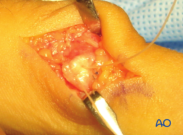 Approximate the collateral ligament to the reattachment site by extending the finger. 