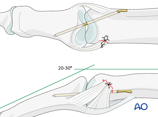Insert a K-wire across the PIP joint obliquely, with the finger in 20-30 degrees of flexion.