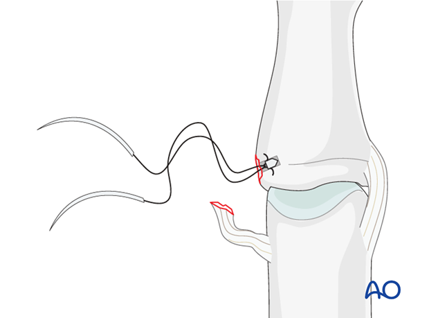 Insert a 1.3 mm anchor into the drill hole.