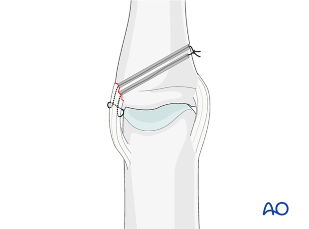 If suture anchors are not available, an alternative method is to thread the sutures through two fine oblique drill holes ....