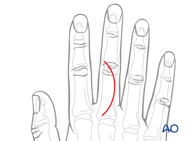 Dorsal approach to the phalangeal metaphysis (after Pratt)