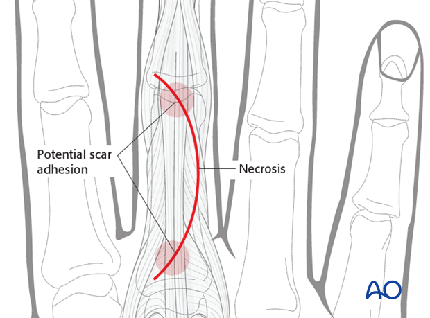 Dorsal approach to the phalangeal metaphysis (after Pratt)
