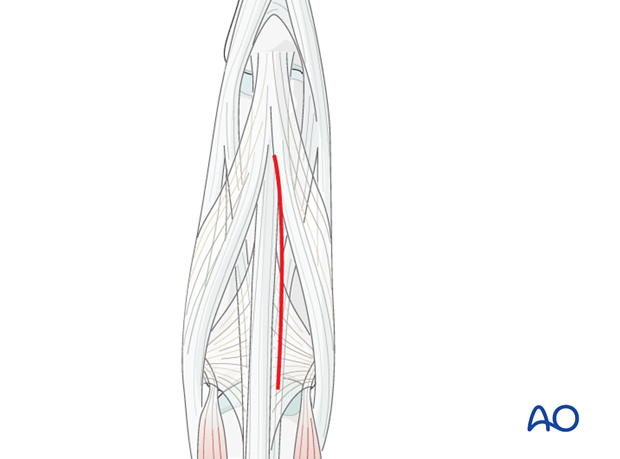 Dorsal approach to the phalangeal metaphysis (after Pratt)