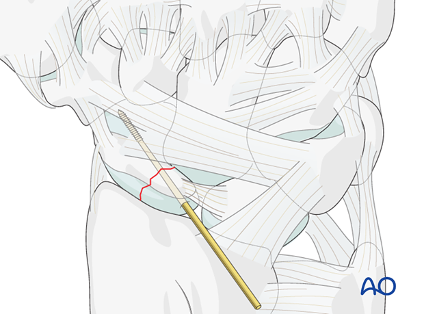 Scaphoid Proximal pole fractures Screw fixation