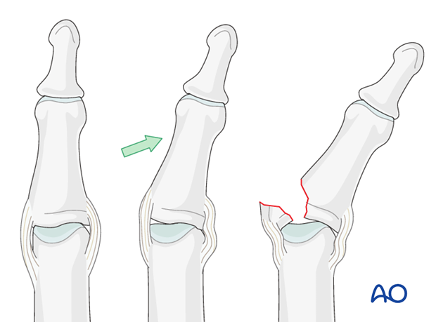 Avulsion fractures are the result of side-to-side (coronal) forces acting on the finger, putting the collateral ligament ...