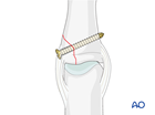 proximal collateral ligament avulsion