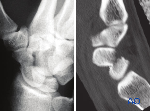 Scaphoid displaced waist fractures – Scerw and K-wire fixation