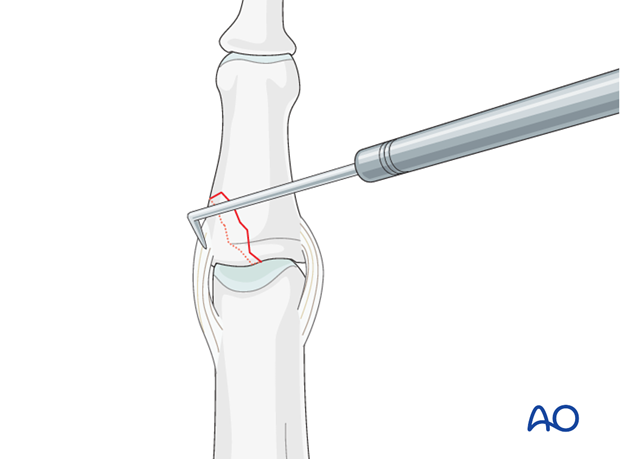 A dental pick is used gently to reduce the fracture from palmar to dorsal and from proximal to distal. 