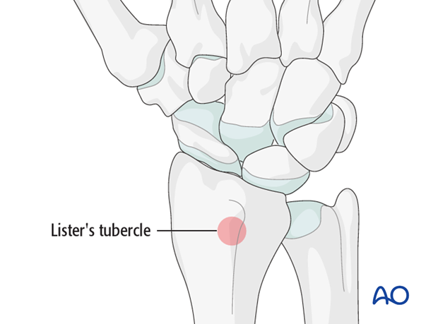 Harvest the bone graft material from the distal radius. A good and safe place for this is just proximal to Lister’s tubercle.