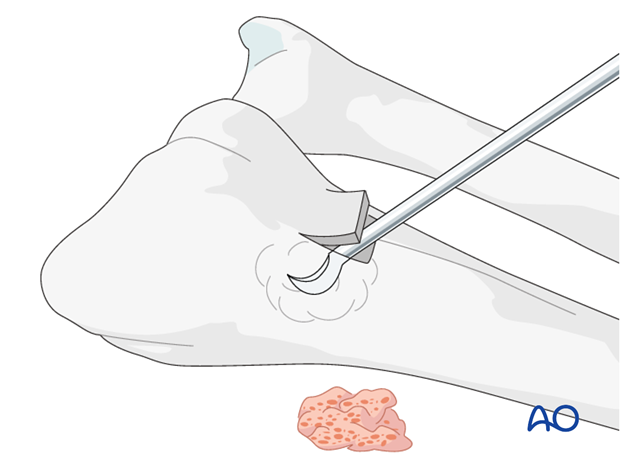 Use a chisel to cut three sides of a square. Hinge up the dorsal cortical flap. After harvesting cancellous bone, replace ...