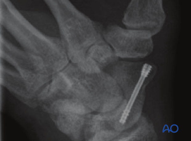 Scaphoid displaced waist fractures – Scerw and K-wire fixation