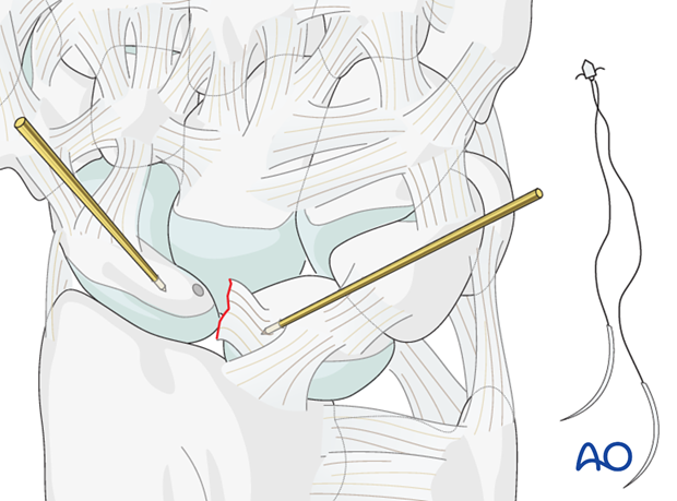 Carpal bones - Perilunate - Scapholunate dissociation - Ligament repair