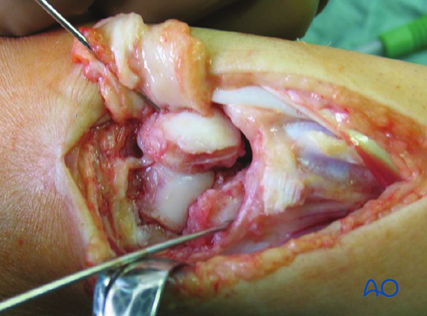 Carpal bones - Perilunate - Scapholunate dissociation - Ligament repair