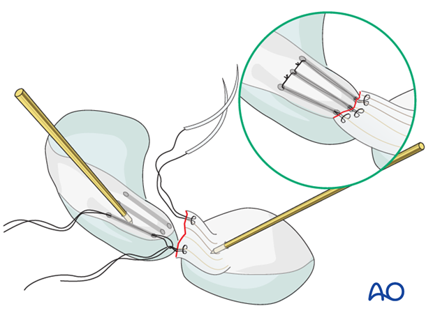 Carpal bones - Perilunate - Scapholunate dissociation - Ligament repair