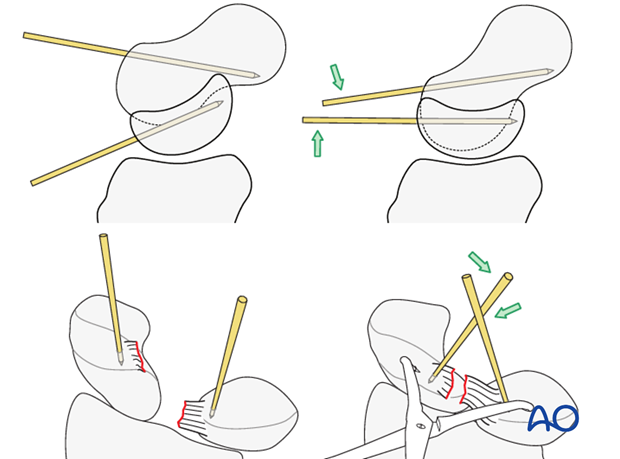 Perilunate – Lunotriquertal dissociation – ORIF – Open reduction internal fixation