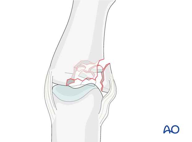 A combination of lateral angulation and axial loading of the finger results in eccentric longitudinal compression forces on ...