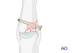proximal multifragmentary