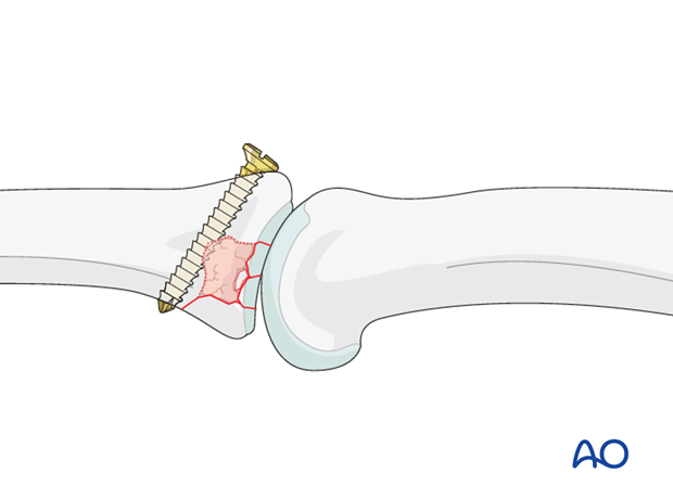 In case of a small cavity, one option is to insert a position screw from dorsal to palmar, just at the distal edge of the ...