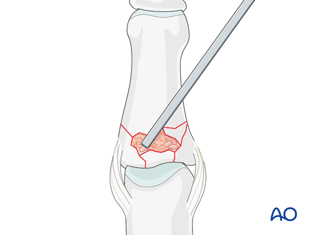 Using a blunt dissector, impact the bone graft and fill the whole fracture cavity.