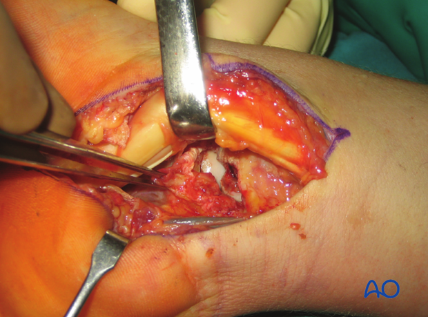 Perilunate – Lunotriquertal dissociation – ORIF – Open reduction internal fixation