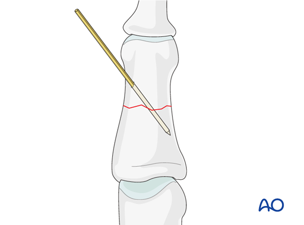 Percutaneous K-wire fixation is often used for fractures of the middle phalangeal diaphysis.