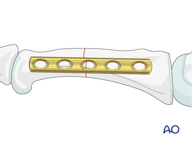 Select a plate with at least 4-5 holes, and center it over the fracture. 