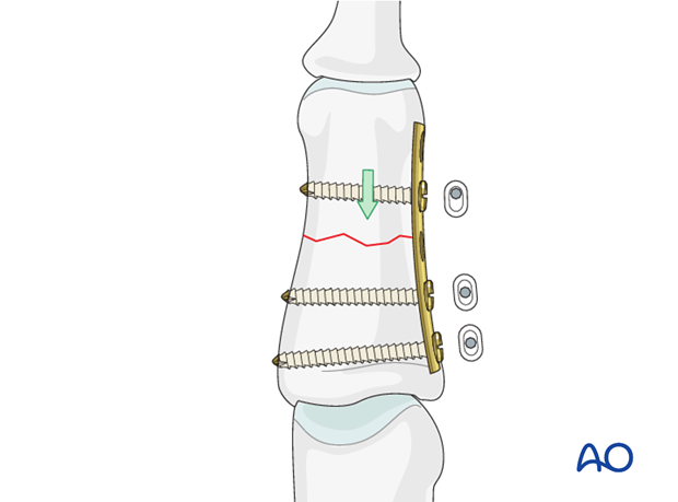 Drill eccentrically for the third screw, through the proximal hole on the other side of the fracture. Measure for screw ...