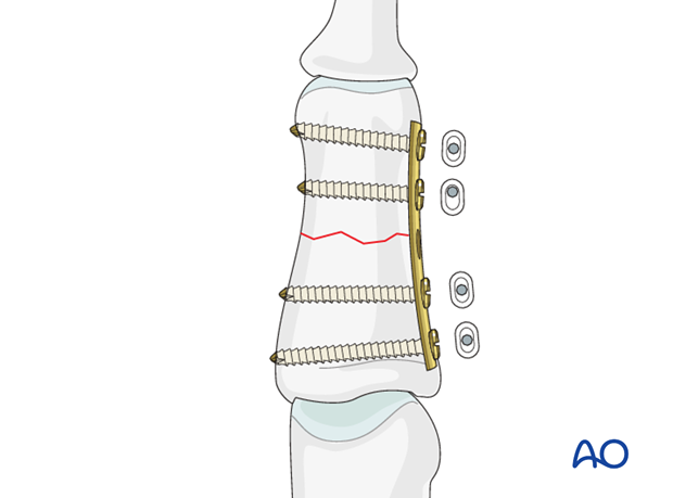 Complete the fixation with the insertion of a neutral fourth screw, after the fashion of the first two screws.