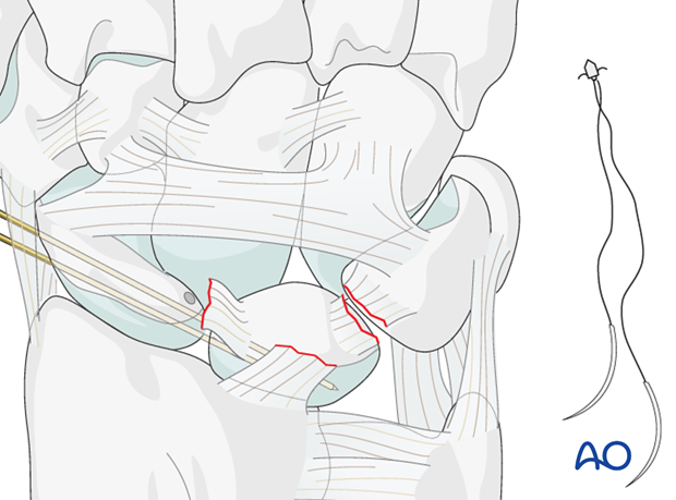 Carpus – Complete dislocation of the luante – ORIF – Open reduction internal fixation