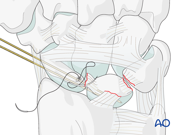 Carpus – Complete dislocation of the luante – ORIF – Open reduction internal fixation