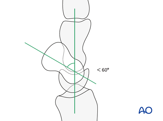 Carpus – Complete dislocation of the luante – ORIF – Open reduction internal fixation