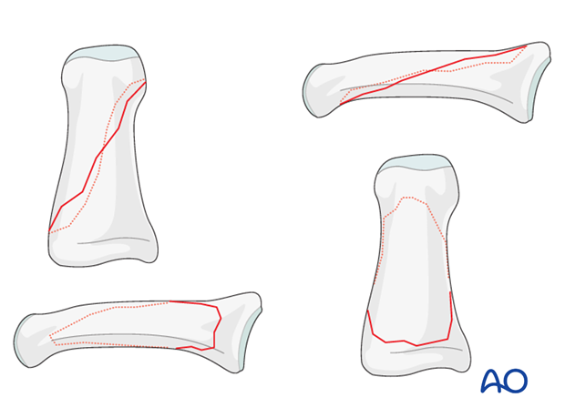 Fractures of the diaphysis can be transverse, oblique, or comminuted.