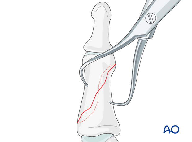 Direct reduction is necessary when the fracture can not be reduced by traction and flexion, or is unstable.