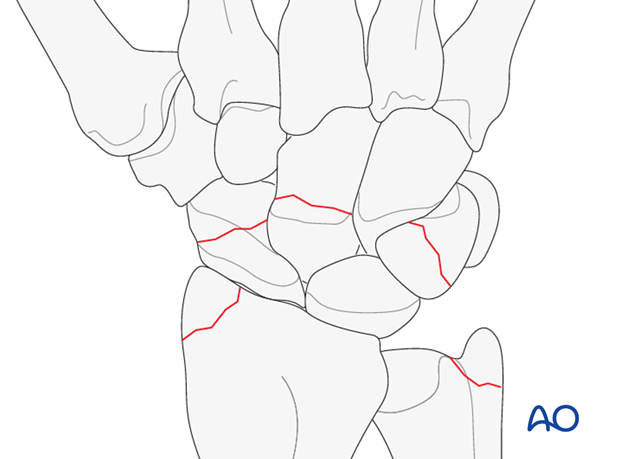 Carpus – Perilunate fractures – Open reduction internal fixation