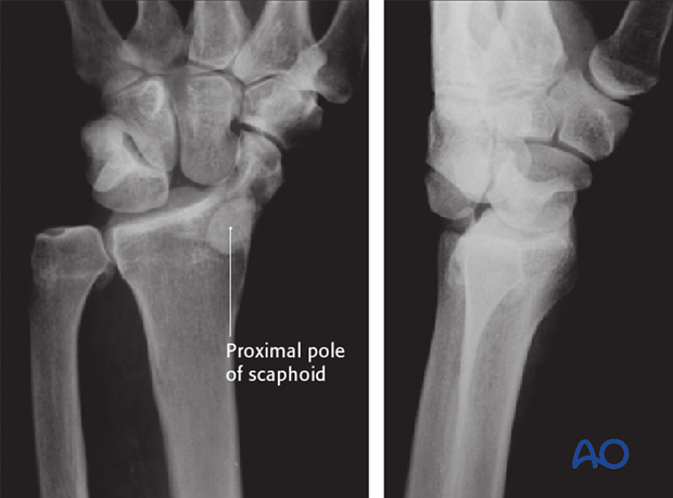 Carpus – Perilunate fractures – Open reduction internal fixation