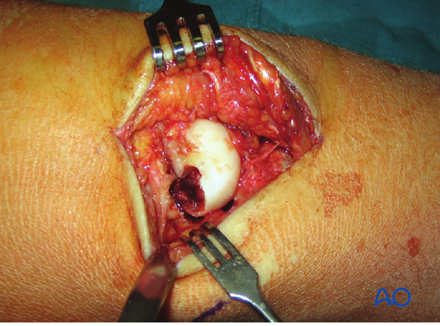 Carpus – Perilunate fractures – Open reduction internal fixation