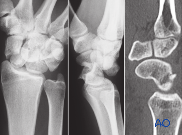 Carpus – Perilunate fractures – Open reduction internal fixation